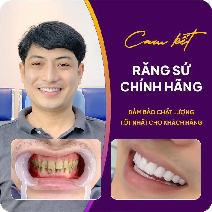 Trước và sau khi mài răng của khách hàng