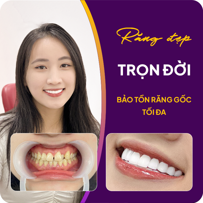 Trước và sau khi mài răng của khách hàng