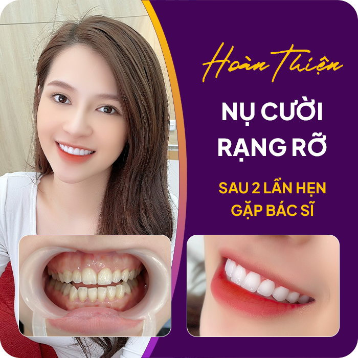 Trước và sau khi mài răng của khách hàng