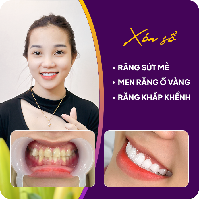 Trước và sau khi mài răng của khách hàng