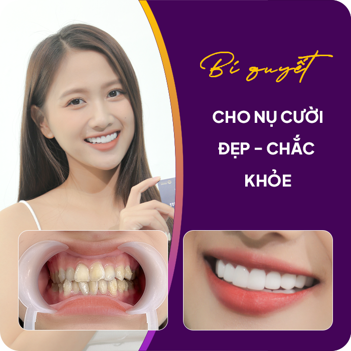 Trước và sau khi mài răng của khách hàng