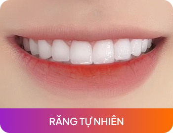 Răng tự nhiên