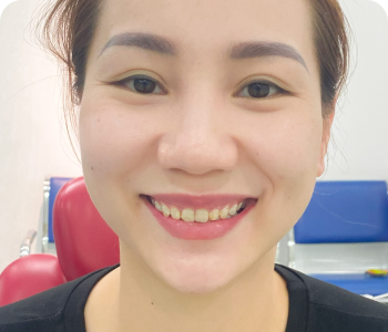 Trước khi mài răng