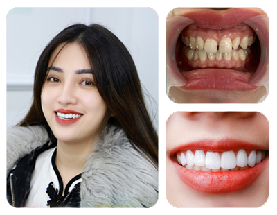 Răng sứ HT Smile