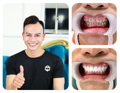 Răng sứ ceramill