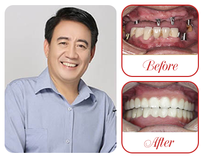 Cấy Implant toàn hàm