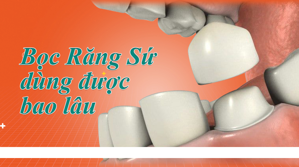 Bọc răng sứ sử dụng được bao lâu?