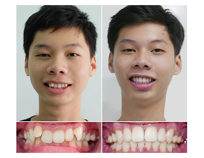 CÔNG NGHỆ NIỀNG RĂNG MỚI NHẤT HIỆU QUẢ VÀ TIẾT KIỆM THỜI GIAN