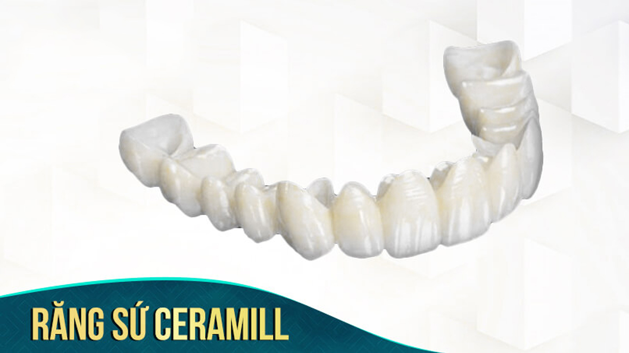 Răng sứ Ceramill: Răng toàn sứ Đức cao cấp