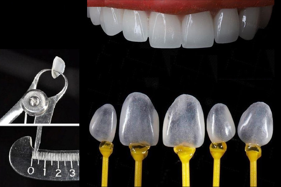 Răng sứ Ultrathin: Giải pháp nụ cười hoàn hảo không xâm lấn