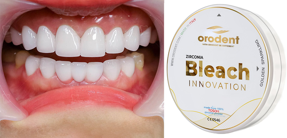 Răng sứ Orodent Bleach Innovation: Nâng tầm đẳng cấp nụ cười Việt
