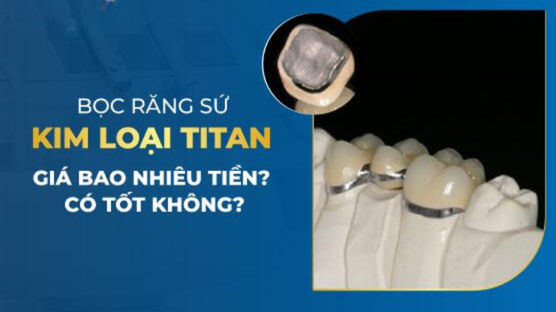 Bọc Răng Sứ Kim Loại Titan Giá Bao Nhiêu Tiền? Có Tốt Không?