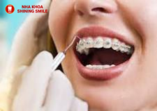 50 tuổi có niềng răng được không