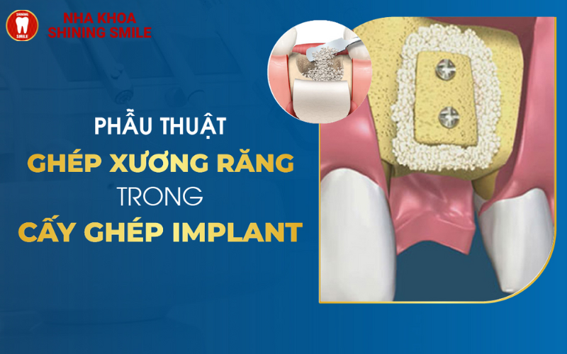 Phẫu Thuật Ghép Xương Răng Trong Cấy Ghép Implant