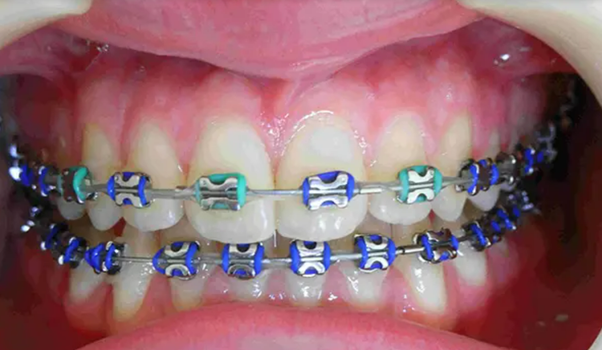 Ưu điểm và hạn chế của niềng răng mắc cài kim loại buộc chun