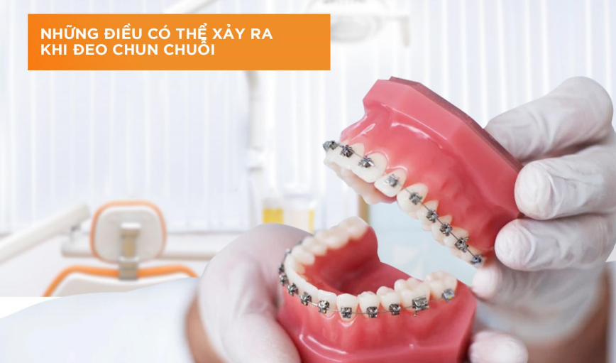 Chun chuỗi niềng răng là gì?  Công dụng và những điều cần biết