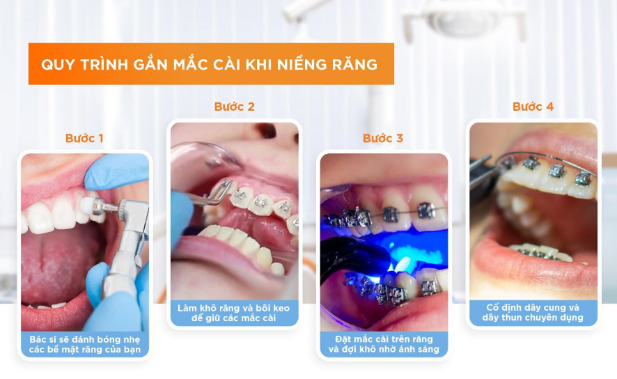 Quy trình gắn mắc cài chuẩn khoa học nhất hiện nay