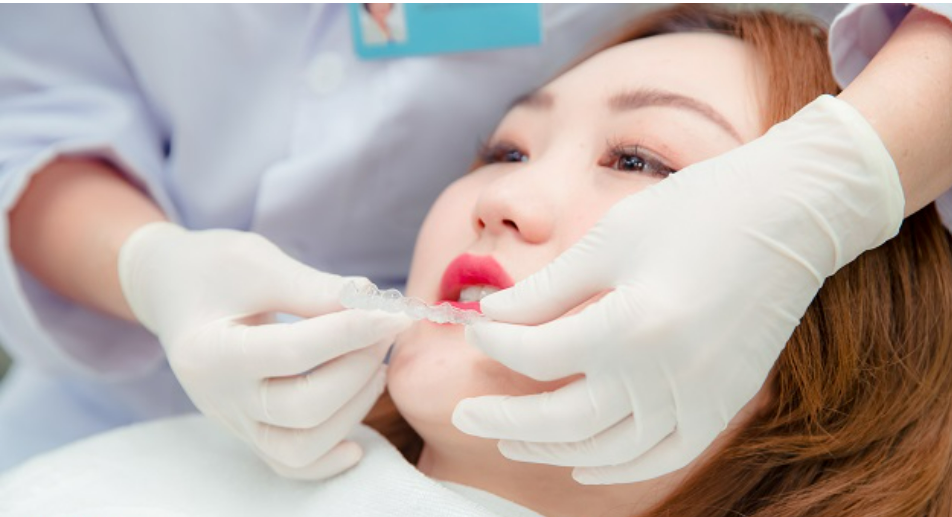 Niềng răng lệch khớp cắn và những điều quan trọng cần biết