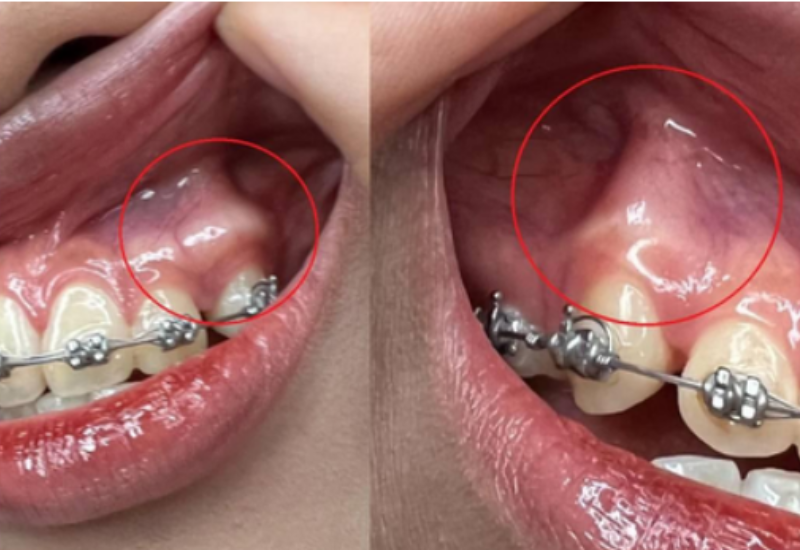 Tại sao lại bị bật chân răng khi niềng răng? Cách nhận biết và xử lý