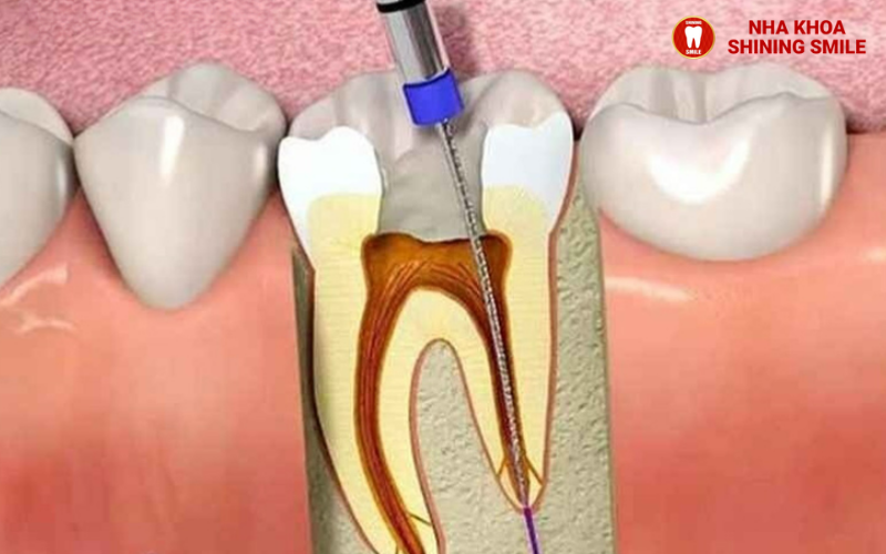 Giải đáp chi tiết: Răng đã lấy tủy có niềng được không?