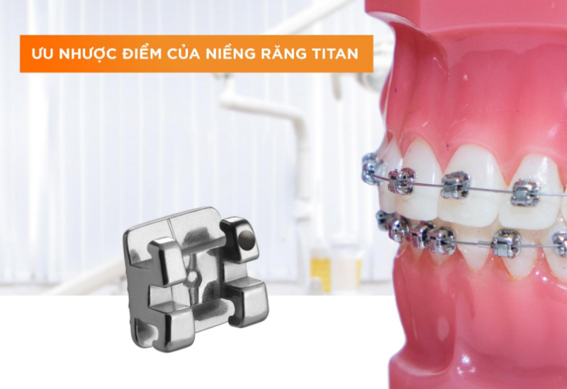 Niềng răng mắc cài Titan là gì? Chi phi bao nhiêu?