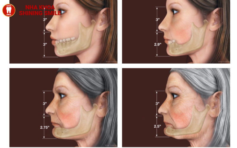 Nhổ Răng Số 7 Bao Lâu Thì Trồng Lại? Giải Đáp Chuyên Sâu Từ Nha Khoa