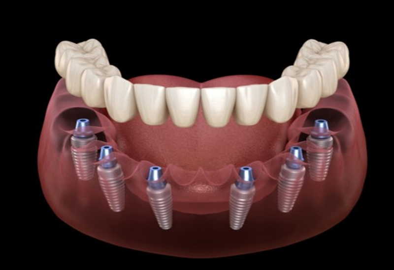 Implant toàn hàm - Hàm răng giả thế hệ mới, tự tin ăn nhai mọi món ngon