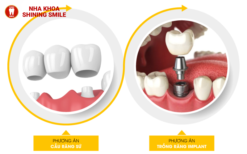 Chữa Tủy Răng Hết Bao Nhiêu? Nên Chọn Địa Chỉ Uy Tín Nào?