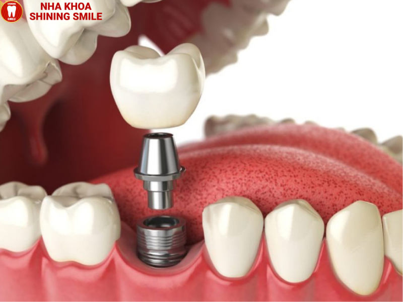 Trồng răng cấm giá bao nhiêu - Bí mật cho nụ cười triệu đô