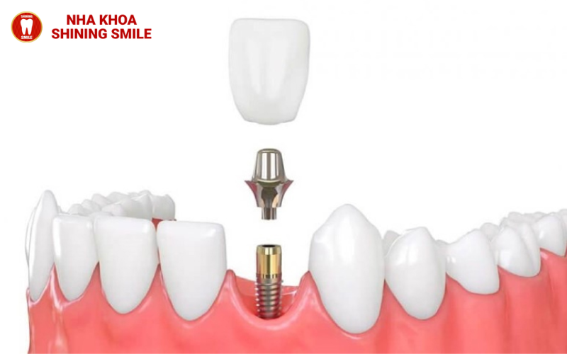 Nên chọn cầu răng sứ hay implant?