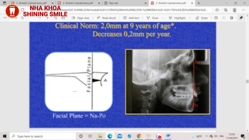 Thách Thức Trong Các Case Niềng Răng Khó: Giải Pháp Từ Nha Khoa Shining Smile