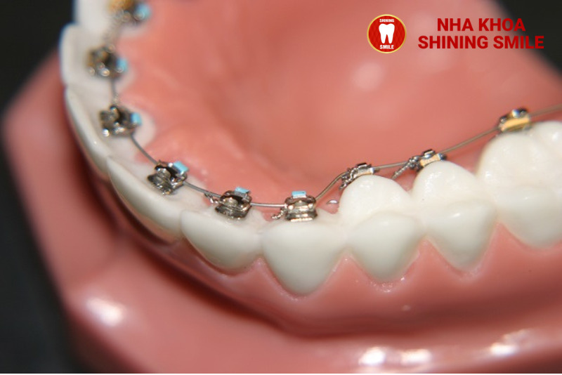 Niềng Răng Đẹp Cỡ Nào? Tìm Hiểu Sự Thay Đổi Ngoạn Mục Sau Điều Trị