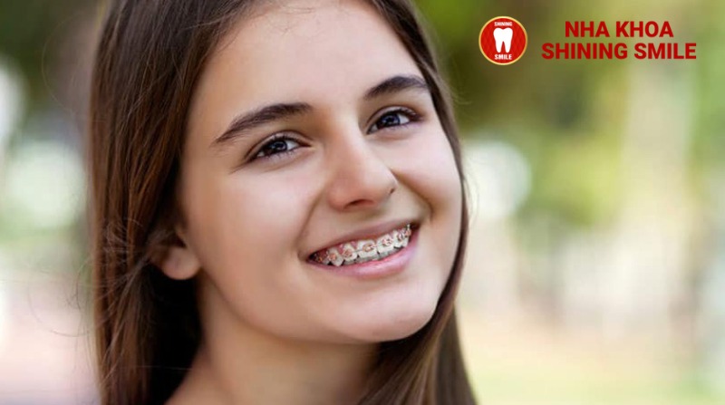 24, 25, 26 Tuổi Niềng Răng Được Không: Liệu Có Quá Muộn Để Cải Thiện Nụ Cười?