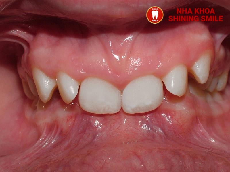 Quy Trình Niềng Răng Khớp Cắn Sâu: Giải Pháp Tại Nha Khoa Shining Smile