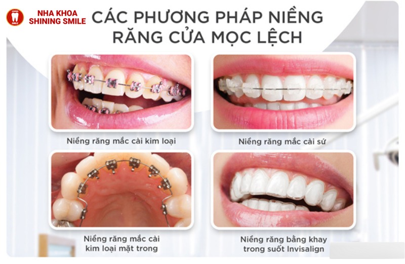 Biến Hóa Nụ Cười Với Niềng Răng Cửa Bị Lệch: Phương Pháp Chỉnh Nha Hiệu Quả