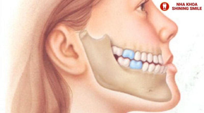 Niềng Răng Móm: Liệu Có Cần Phải Nhổ Răng Không?