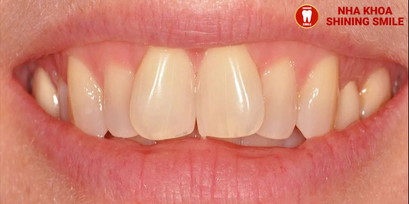 Niềng Răng Cửa Chữ V: Phương Pháp Hiệu Quả Để Điều Chỉnh Nụ Cười