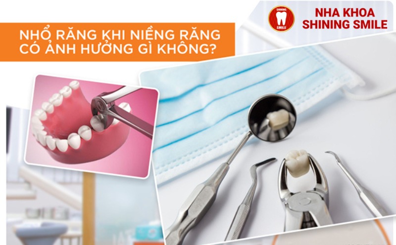 Phải Nhổ Răng Khi Niềng Răng Không? Hiểu Đúng Để Không Lo Lắng