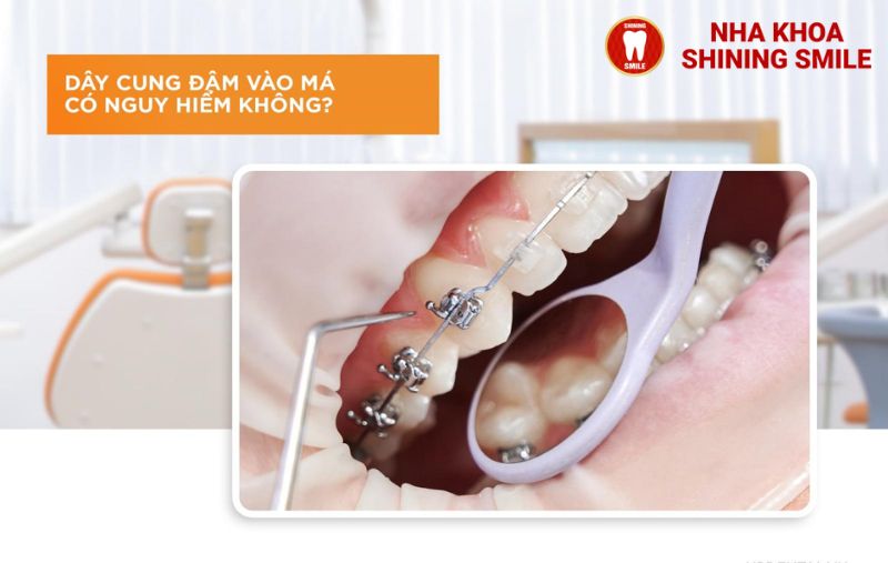 Cách Xử Lý Khi Dây Cung Niềng Răng Đâm Vào Má: Giải Pháp Thực Tiễn