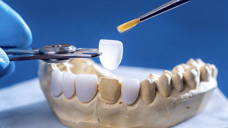 Bọc Răng Sứ Cho Răng Sâu: Giải Pháp Nhanh Chóng Và Hiệu Quả