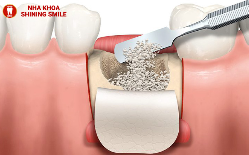 cay-ghep-mang-xuong-khong-phai-la-ky-thuat-bat-buoc-khi-trong-rang-implant.png