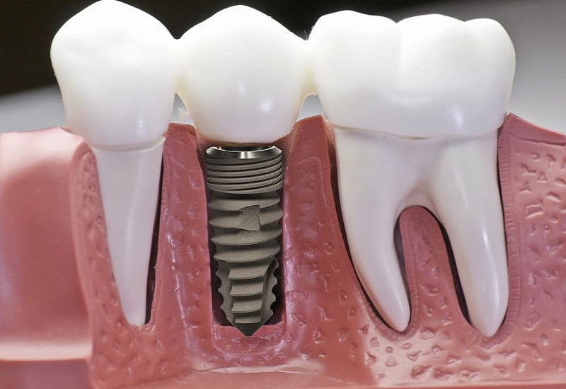 Công Nghệ Implant: Tiên Phong Trong Nha Khoa Hiện Đại