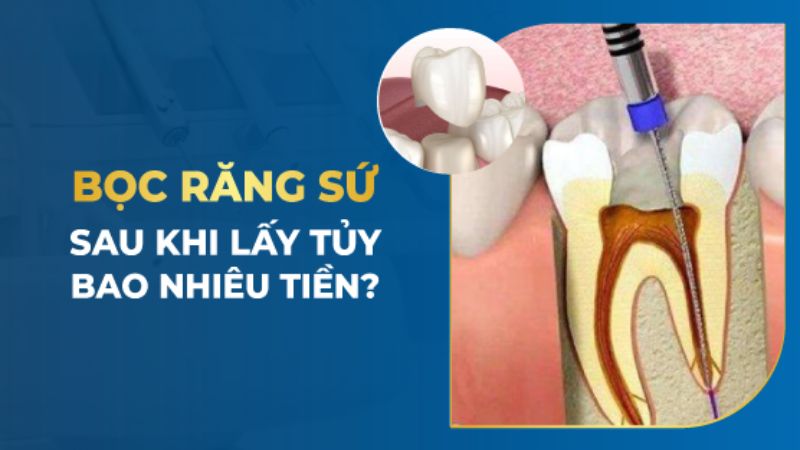 Lấy Tủy Bọc Răng Sứ Giá Bao Nhiêu? Cập Nhật Chi Tiết 2024