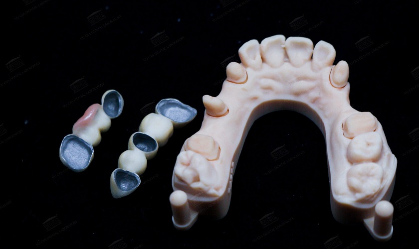 Nhổ Răng Bao Lâu Thì Làm Cầu Răng? Bí Quyết Để Có Nụ Cười Đẹp