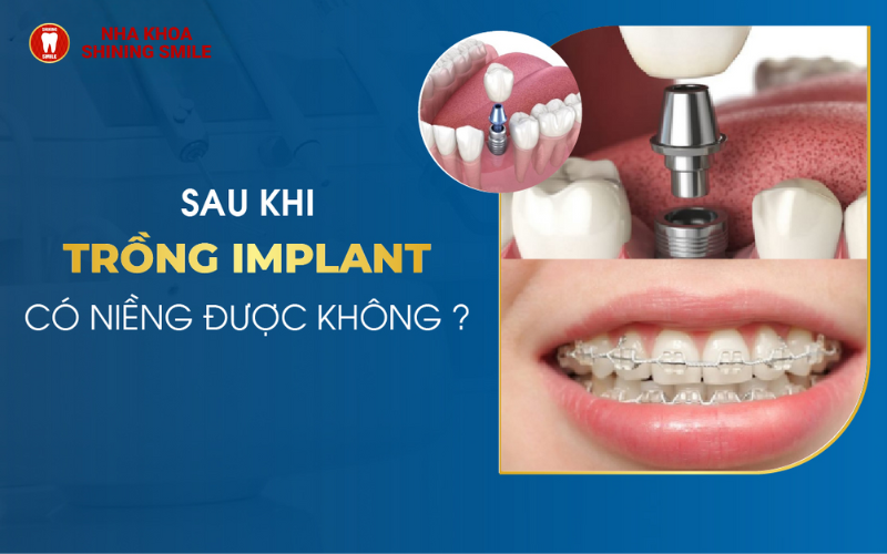 Trồng Răng Có Niềng Được Không? Chuyên Gia Giải Đáp