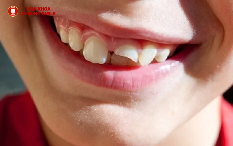 Trồng Răng Rụng Gắn: Phương Pháp Đột Phá Cho Nụ Cười Rạng Rỡ