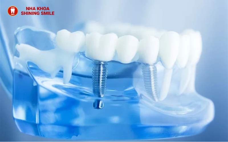 Trồng Răng Trả Góp: Giải Pháp Tài Chính Linh Hoạt Cho Nụ Cười Hoàn Hảo