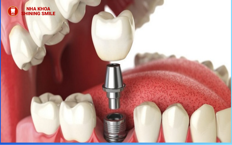 Mất Chân Răng Có Trồng Được Không? Giải Pháp Bất Ngờ Từ Chuyên Gia