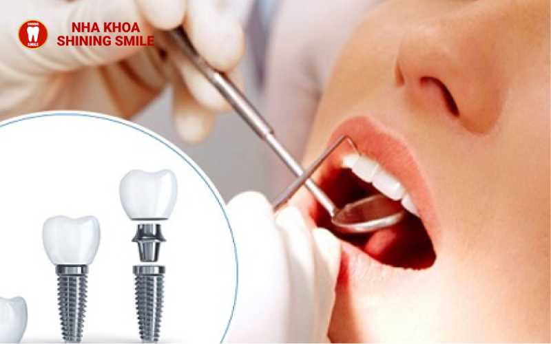 Mất Răng Lâu Năm Có Trồng Được Không? Khám Phá Giải Pháp Đột Phá