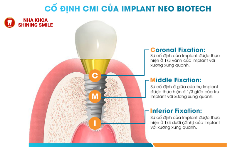 Neobiotech Implant: Công Nghệ Trồng Răng Đỉnh Cao Cho Nụ Cười Hoàn Hảo